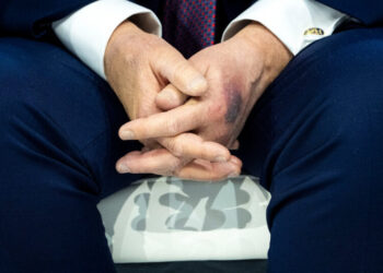 Trump Says He Bruised His Hand on a Table