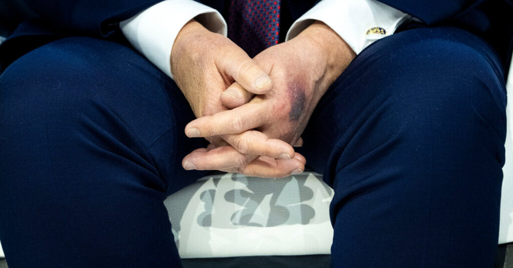 Trump Says He Bruised His Hand on a Table