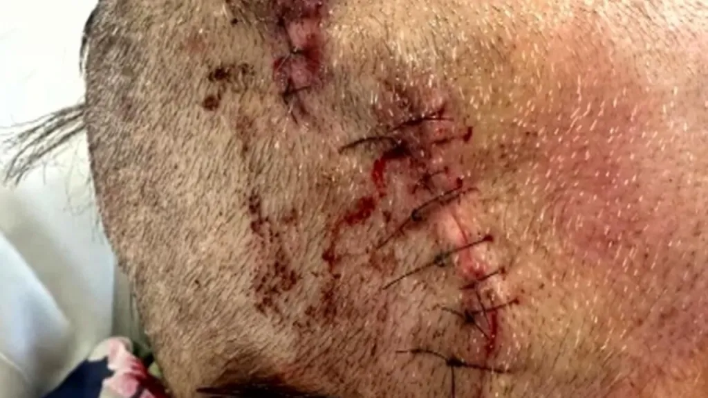 Rosalia's stitched-up head wound after being hit by shrapnel.