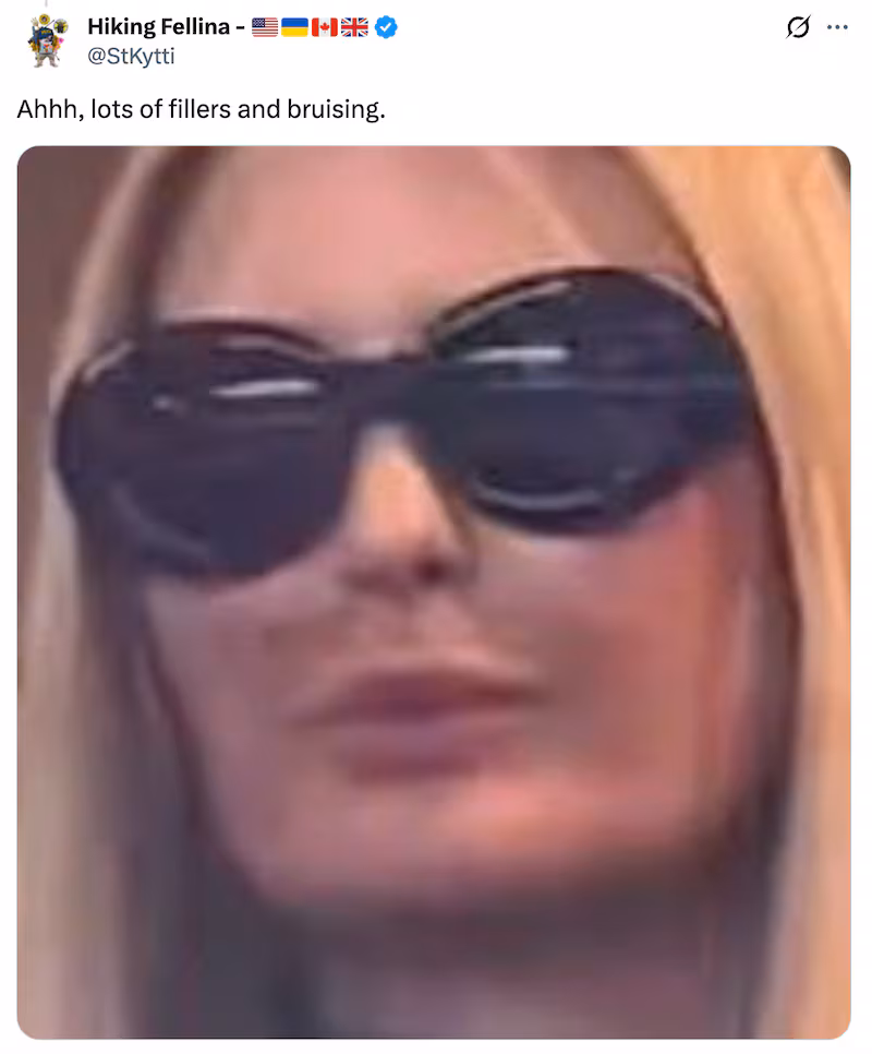 X user sees lip fillers and bruising in pictures of Ivanka