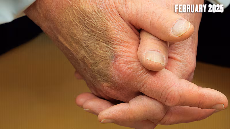 Donald Trump wore make-up to cover a large bruise on his hand during a February meeting with 47-year-old French President Emmanuel Macron.