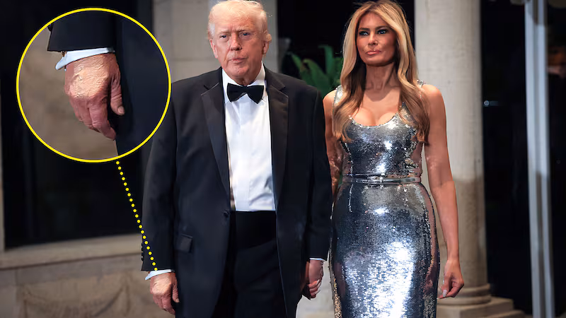 Donald Trump and Melania Trump on New Year's Eve with a close up of the makeup on Donald's hand