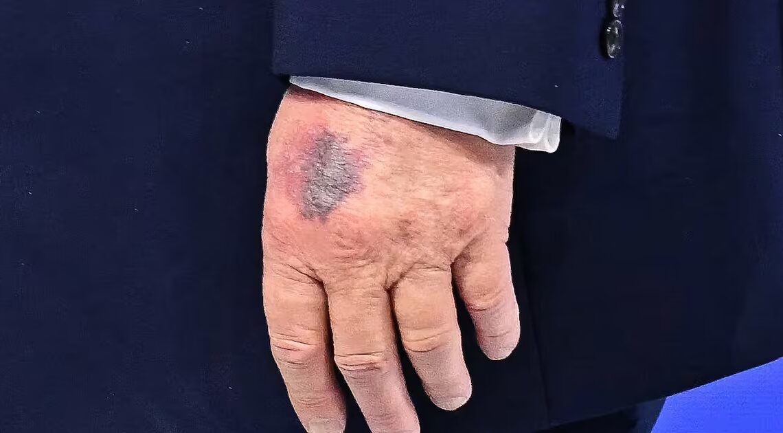 Trump’s Chronic Health Issue on Full Display at His Special Event