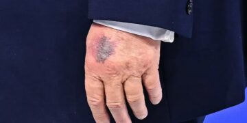 Trump’s Chronic Health Issue on Full Display at His Special Event