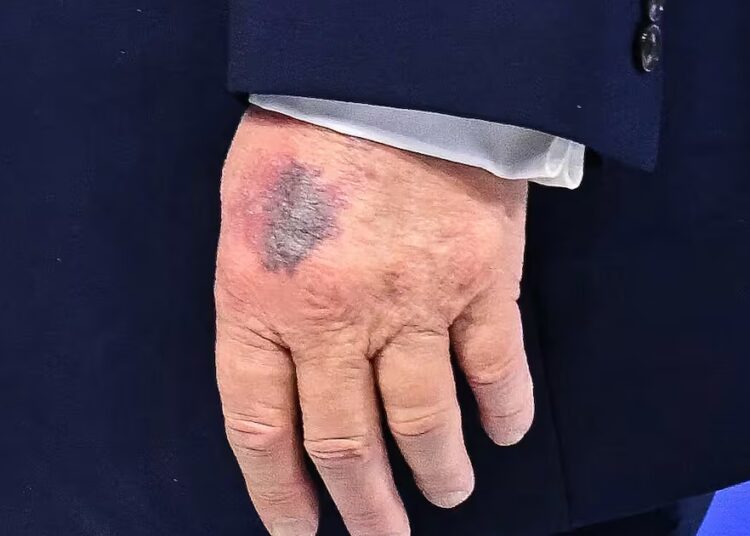 Trump’s Chronic Health Issue on Full Display at His Special Event