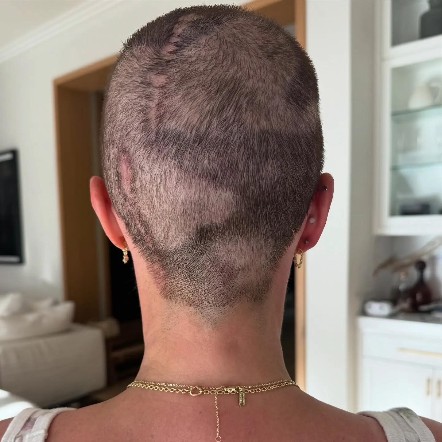 Back of a head with short, patchy hair growth, showing several scars on the scalp and gold necklaces on the neck.