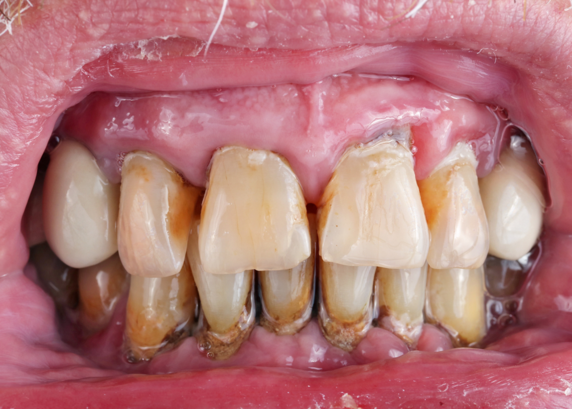 Take Care of Your Teeth, or Else You’ll Die Sooner