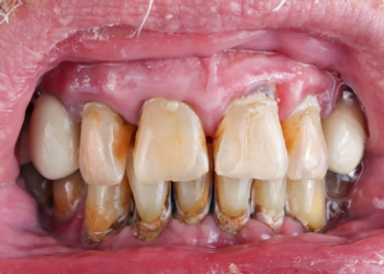 Take Care of Your Teeth, or Else You’ll Die Sooner