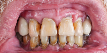 Take Care of Your Teeth, or Else You’ll Die Sooner