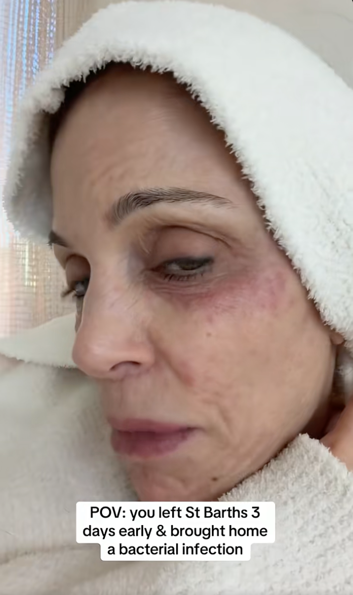 Bethenny Frankel with a bacterial infection and redness around her eyes.