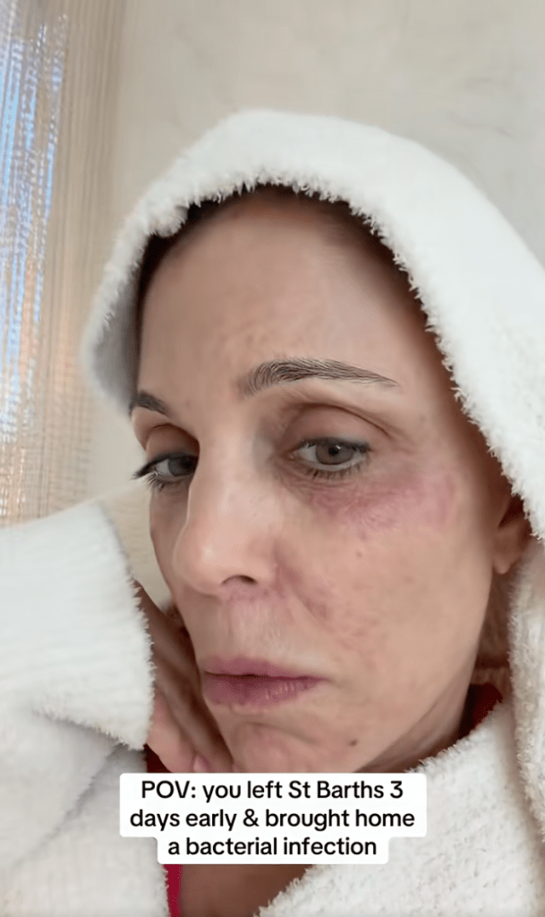 Bethenny Frankel with a bacterial infection on her face.