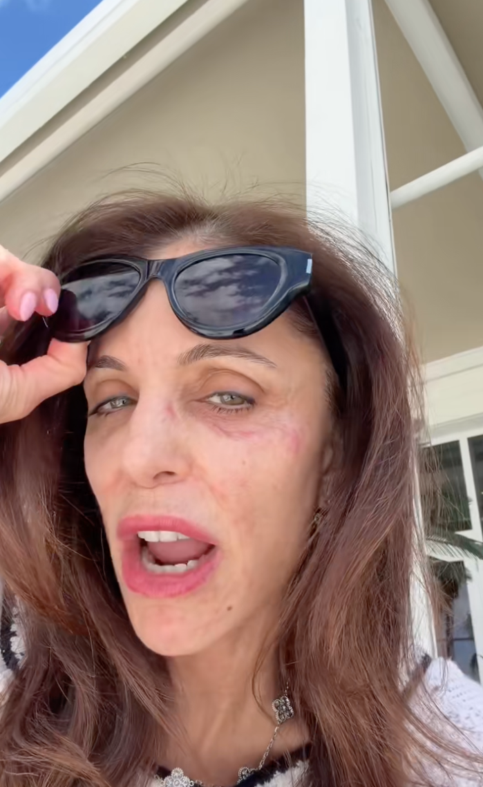 Bethenny Frankel shows a bacterial infection on her face, acquired from hotel towels in St. Barts.