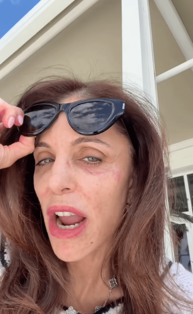 Bethenny Frankel showing the bacterial infection on her face.