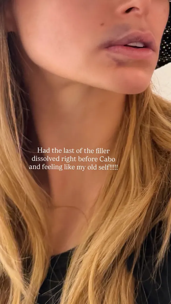 Close-up of a woman's face, showing bruising on and around her lips after getting lip filler dissolved.