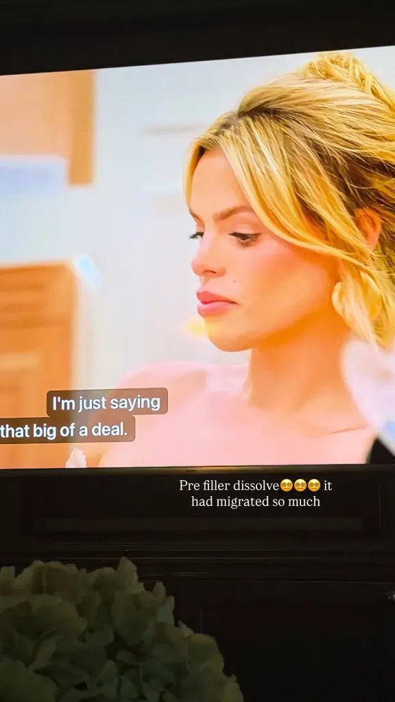 Brooks Nader before filler was dissolved, showing how it had migrated.