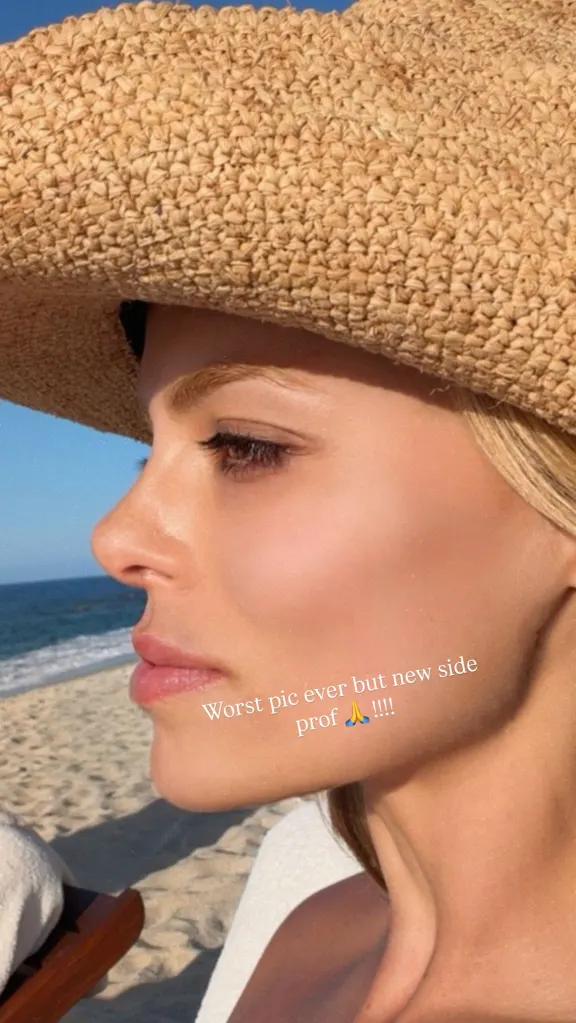 Brooks Nader celebrating getting her filler dissolved, with a caption saying 