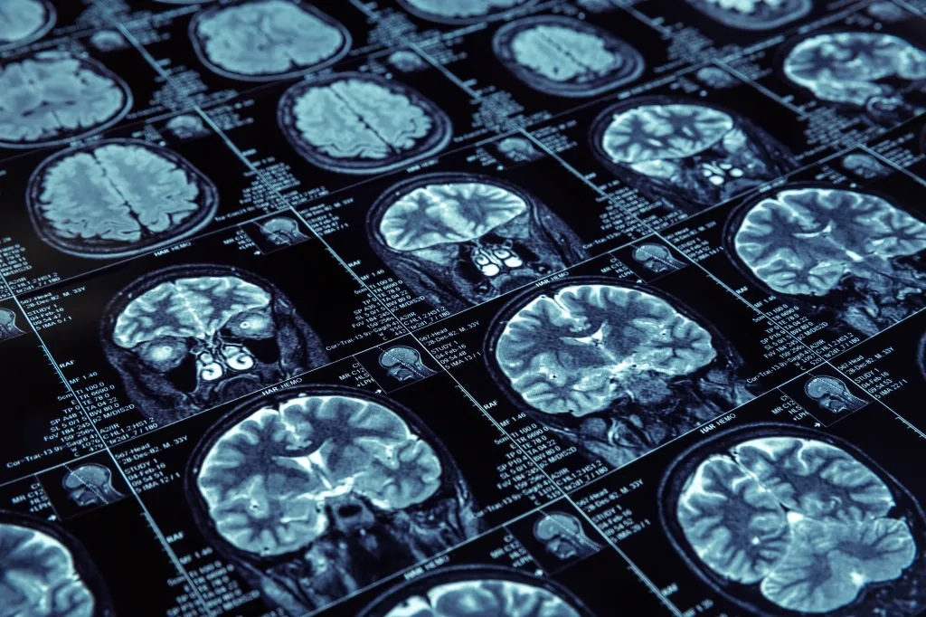 Magnetic resonance imaging (MRI) scans showing multiple cross-sections of a human brain.