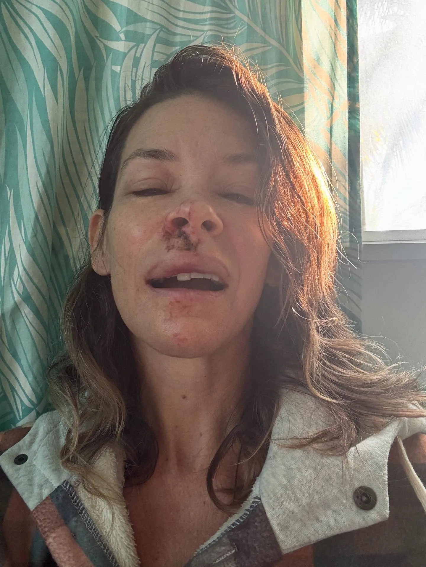 Evangeline Lilly with a bruised nose and lip.