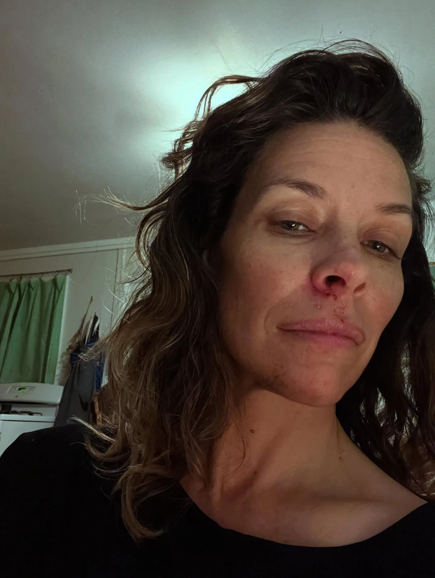 Evangeline Lilly with a red rash under her nose and on her upper lip.