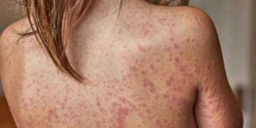 ‘Insane quote’: Harvard professor flabbergasted by new measles plan from admin’s ‘expert’