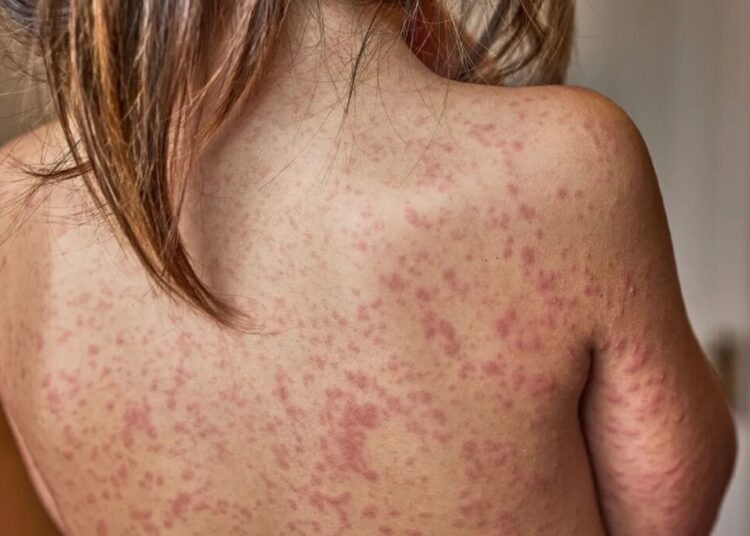 ‘Insane quote’: Harvard professor flabbergasted by new measles plan from admin’s ‘expert’