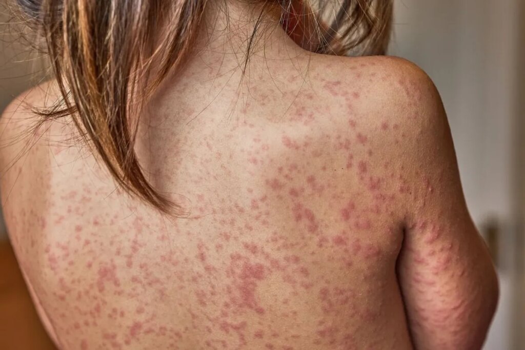‘Insane quote’: Harvard professor flabbergasted by new measles plan from admin’s ‘expert’