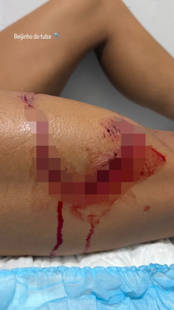 A bitten and bleeding leg with a large red, pixelated area, and blood streaks on the skin.