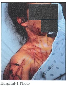 Hospital photo of Natalie Greene's torso and face, showing multiple deep cuts on her shoulder and chest, with portions of her face redacted.