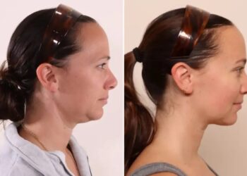 ‘Shrink wrapping’ is the hot new skin-tightening and fat-melting treatment people are getting for ‘Ozempic face’