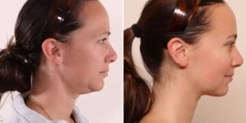 ‘Shrink wrapping’ is the hot new skin-tightening and fat-melting treatment people are getting for ‘Ozempic face’