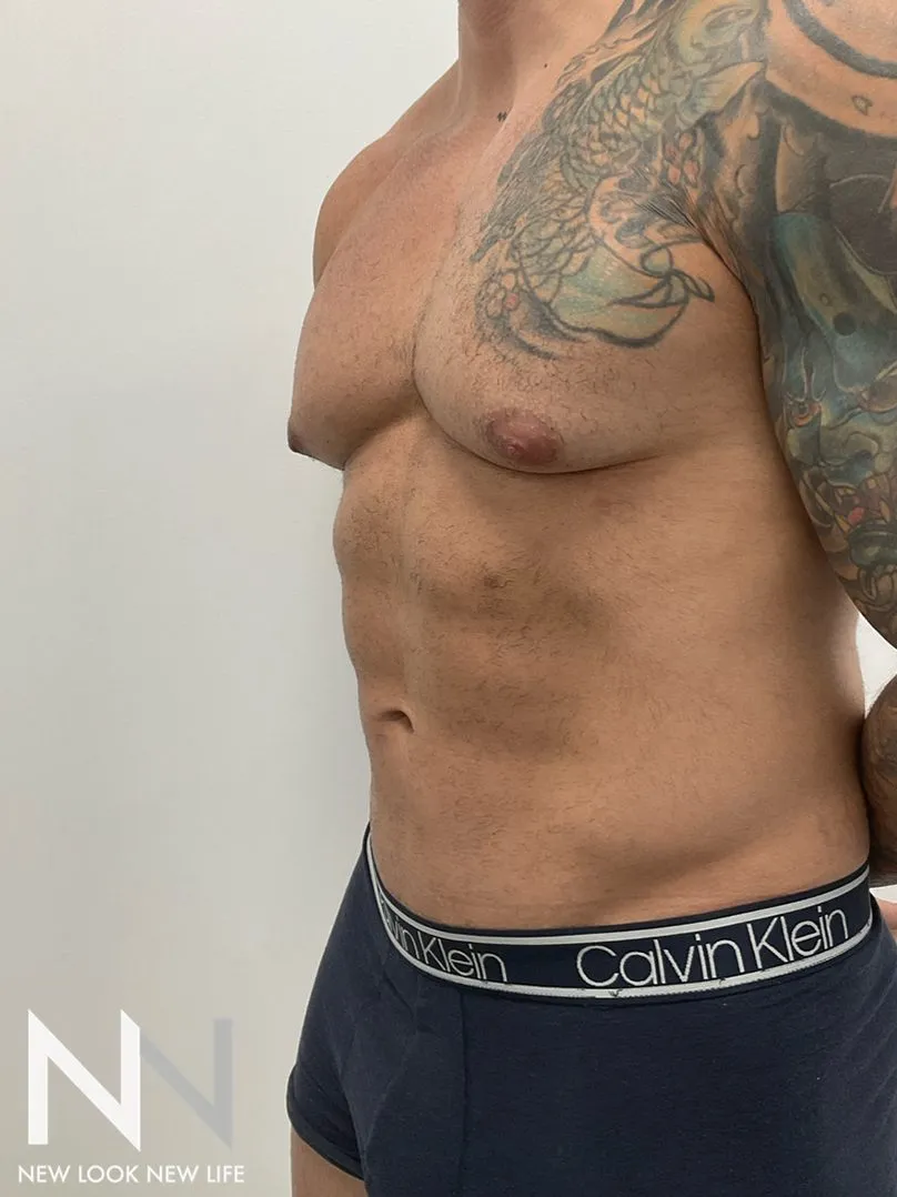 Before and after images of a man showing significant reduction in chest and stomach fat, from the side.