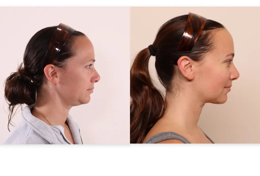 Collage of a woman's profile before and after a skin-tightening treatment