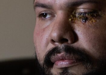 Second man shares horrific story of being blinded by officers at anti-ICE rally in Santa Ana