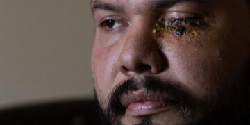 Second man shares horrific story of being blinded by officers at anti-ICE rally in Santa Ana