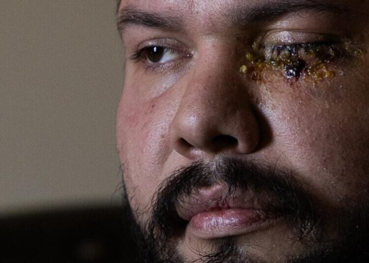 Second man shares horrific story of being blinded by officers at anti-ICE rally in Santa Ana