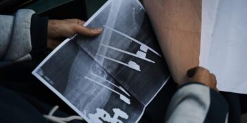 A bullet shattered her knee. Now a Gaza teen’s chances of walking depend on Rafah crossing’s opening