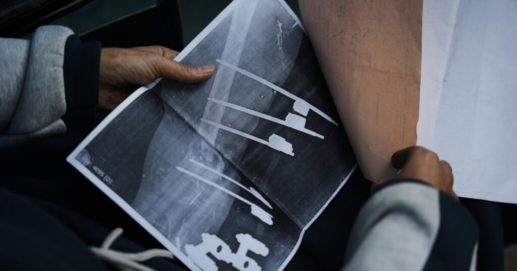 A bullet shattered her knee. Now a Gaza teen’s chances of walking depend on Rafah crossing’s opening