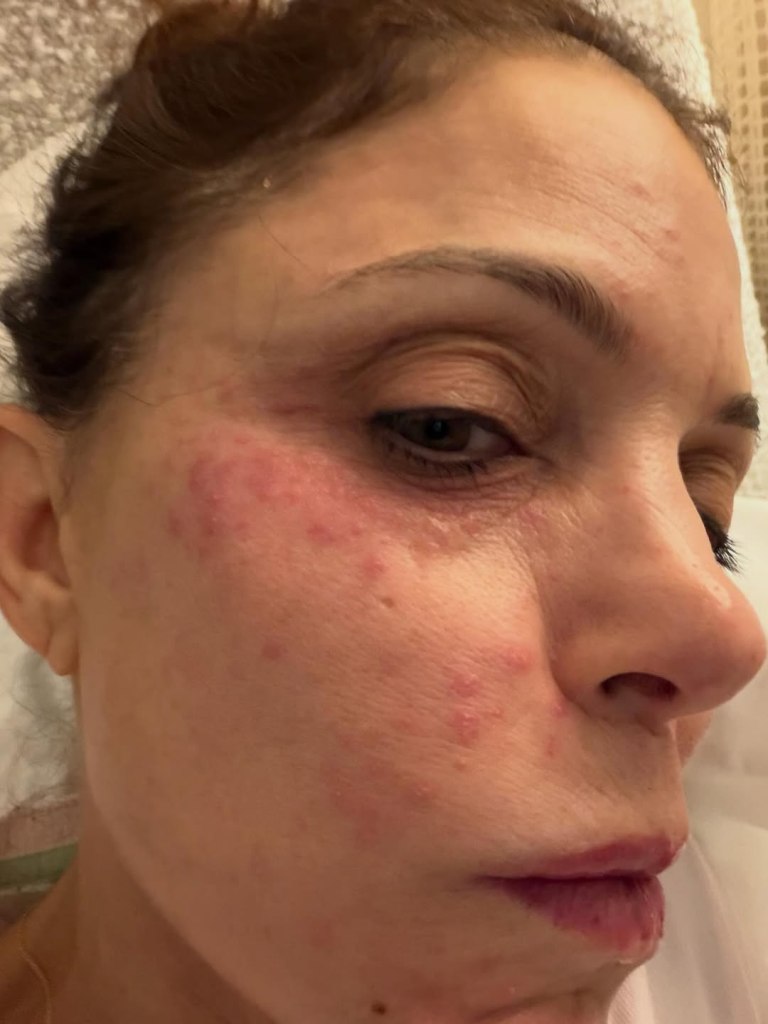 Bethenny Frankel's face showing red irritation and bumps from a bacterial infection.
