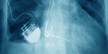 Nancy Guthrie Kidnapping Shows Limits of Tracking Pacemakers in Police Work