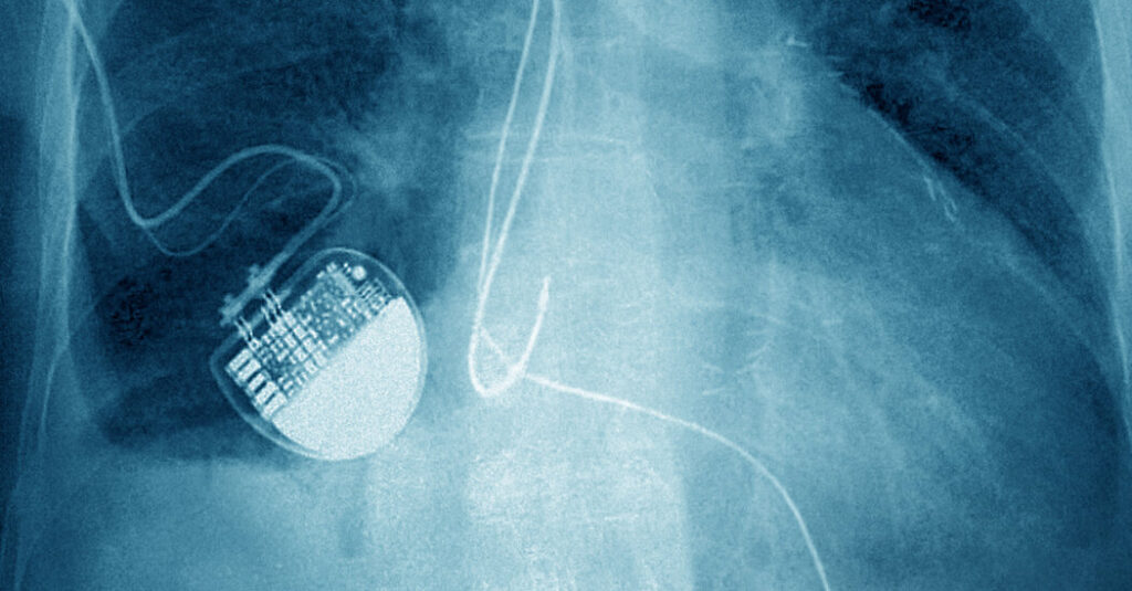 Nancy Guthrie Kidnapping Shows Limits of Tracking Pacemakers in Police Work