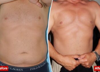 The rise of ‘masculine contouring’: Meet the men ‘optimizing’ their bodies with liposuction