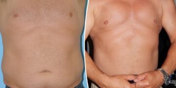 The rise of ‘masculine contouring’: Meet the men ‘optimizing’ their bodies with liposuction