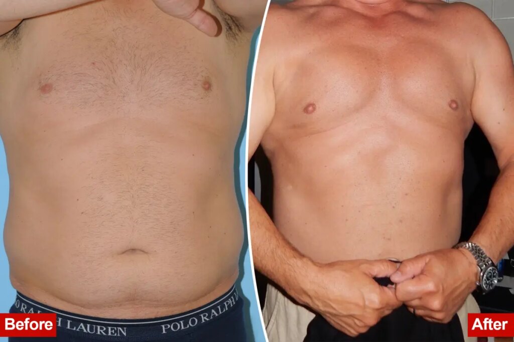 The rise of ‘masculine contouring’: Meet the men ‘optimizing’ their bodies with liposuction