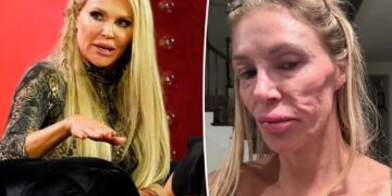 Brandi Glanville shares exorbitant cost of trying to figure out years-long facial parasite mystery