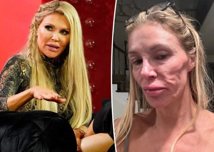 Brandi Glanville shares exorbitant cost of trying to figure out years-long facial parasite mystery