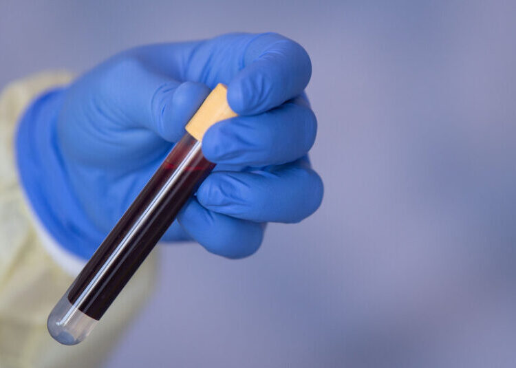 Grail’s Cancer Detection Test Fails in Major Study