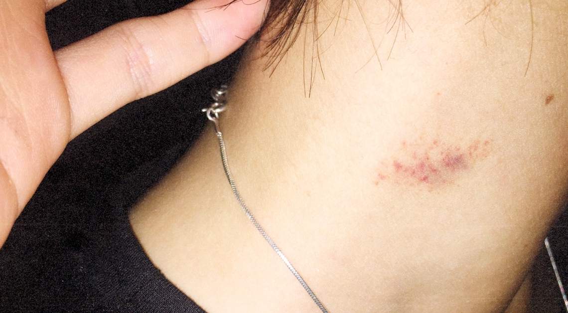 6 Expert-Approved Tips to Get Rid of a Hickey Faster
