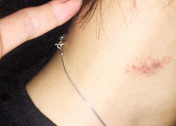 6 Expert-Approved Tips to Get Rid of a Hickey Faster