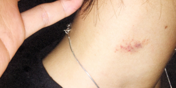 6 Expert-Approved Tips to Get Rid of a Hickey Faster