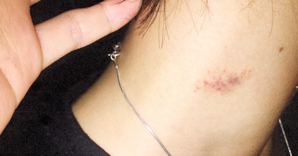 6 Expert-Approved Tips to Get Rid of a Hickey Faster